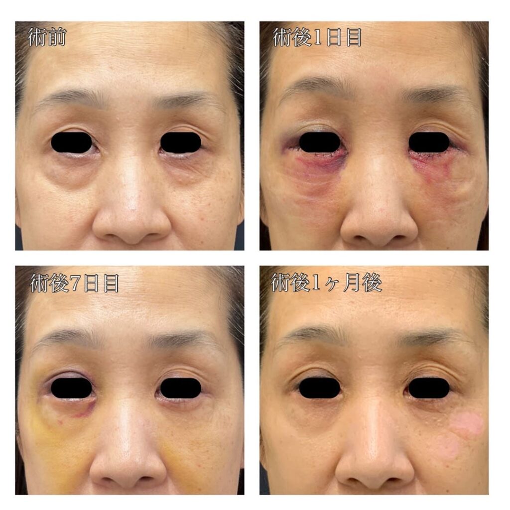 表ハムラ法を受けられたモニター患者様の写真　症例１