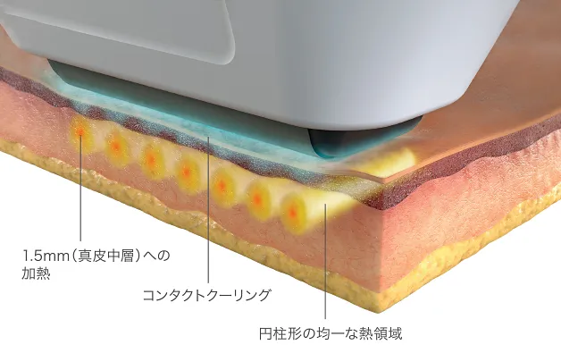 ソフウェーヴのハンドピースを当てた断面イメージ：真皮中層への加熱、コンタクトクーリング、円柱形の熱領域を示した図